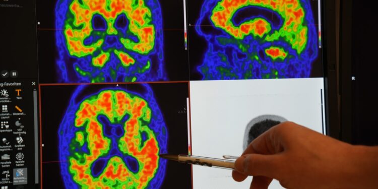 Der Demenz auf der Spur: Strukturierte Demenzabklärung im Salzkammergut Klinikum Vöcklabruck